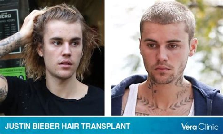Justin Bieber's Hair Transformation: The Journey Of His Hair Transplant