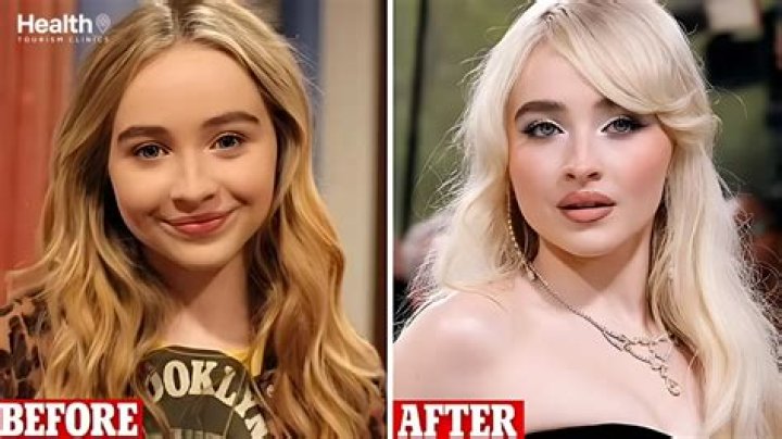 Sabrina Carpenter's Lip Fillers: Exploring The Transformation