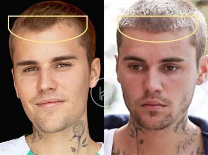 Unlocking The Secrets Of Justin Bieber's Hair Implant Journey