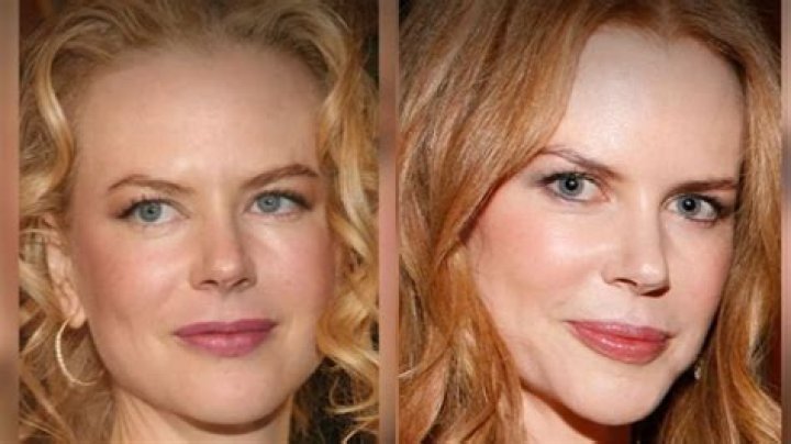 Unveiling The Secrets Behind Nicole Kidman's Procedures