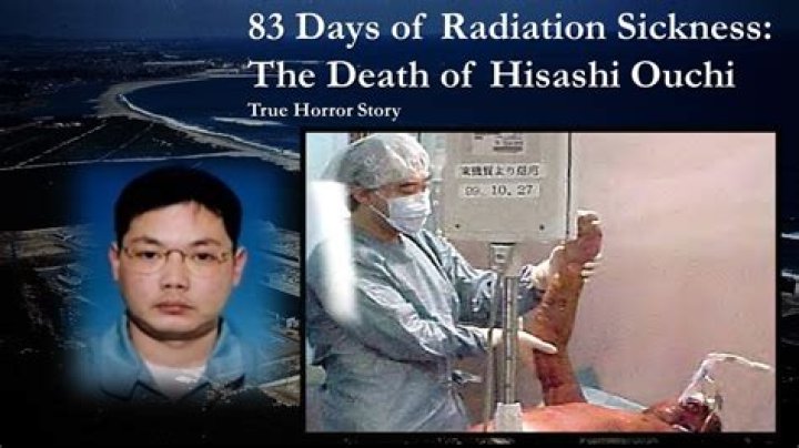 Unveiling The Tragic Tale: Hisashi Ouchi Picture After Radiation