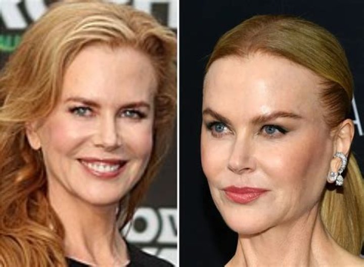 Unveiling The Truth About Nicole Kidman Plastic Surgery